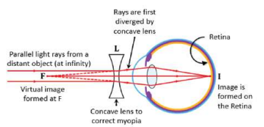 Correction of shortsightedness